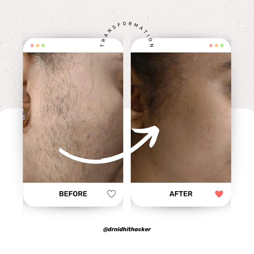 Acne scar removal before and after cheek skin smoothing