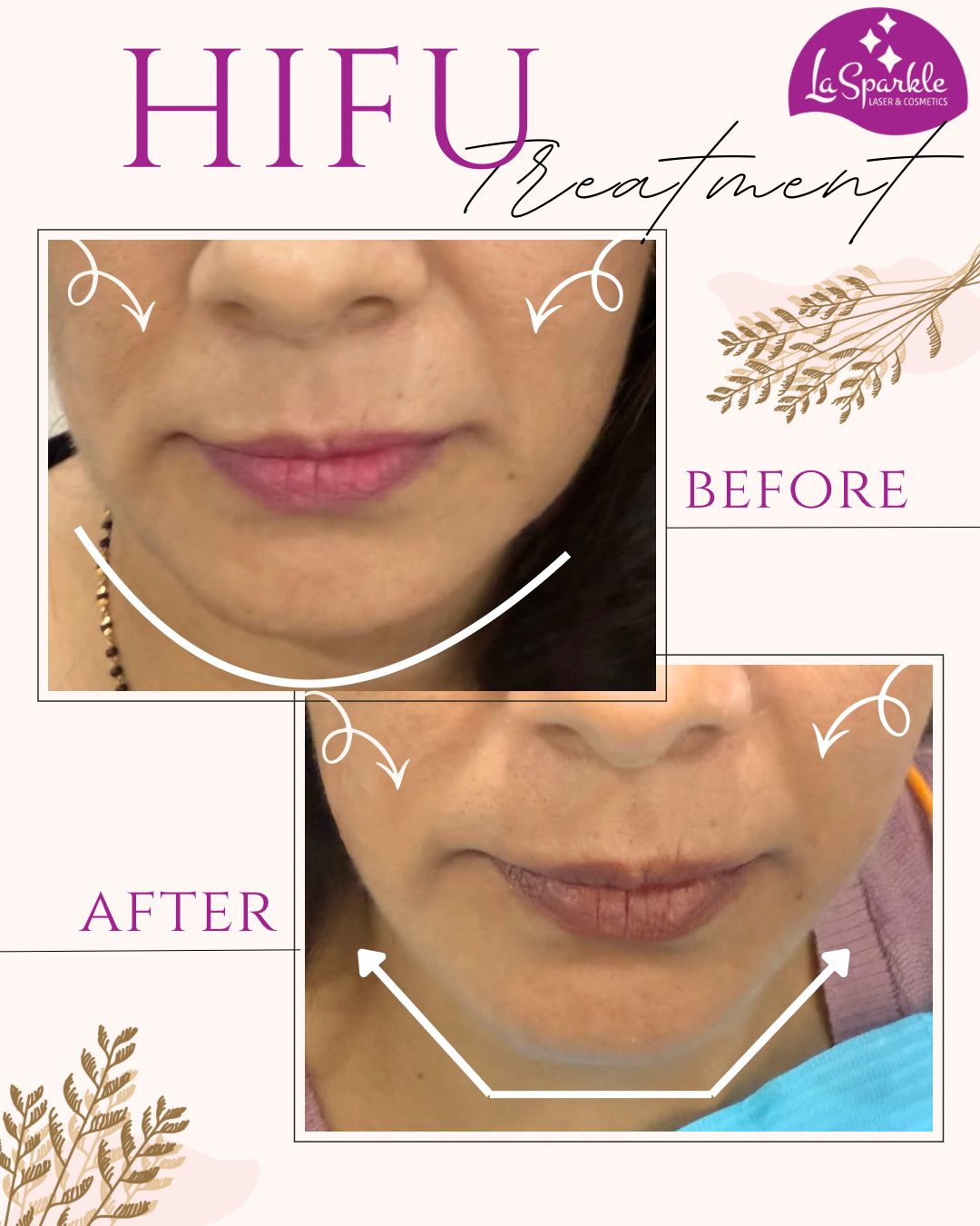 Calmed active acne and improved texture after clinic peel
