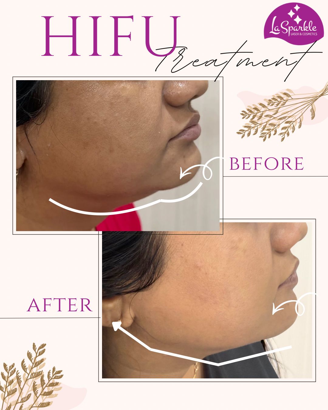 Skin brightening laser toning treatment face clearance