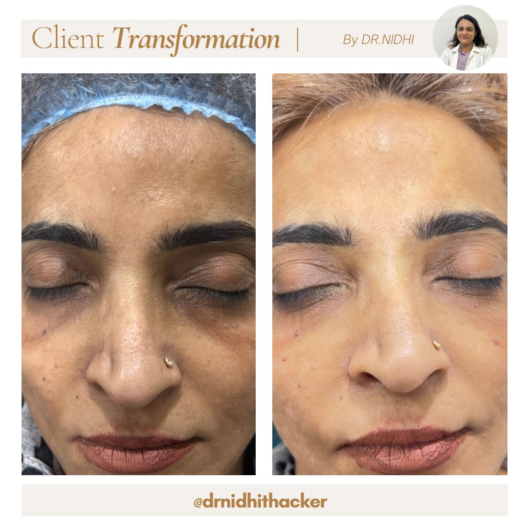 Luminous cheek complexion after tailored skincare therapy