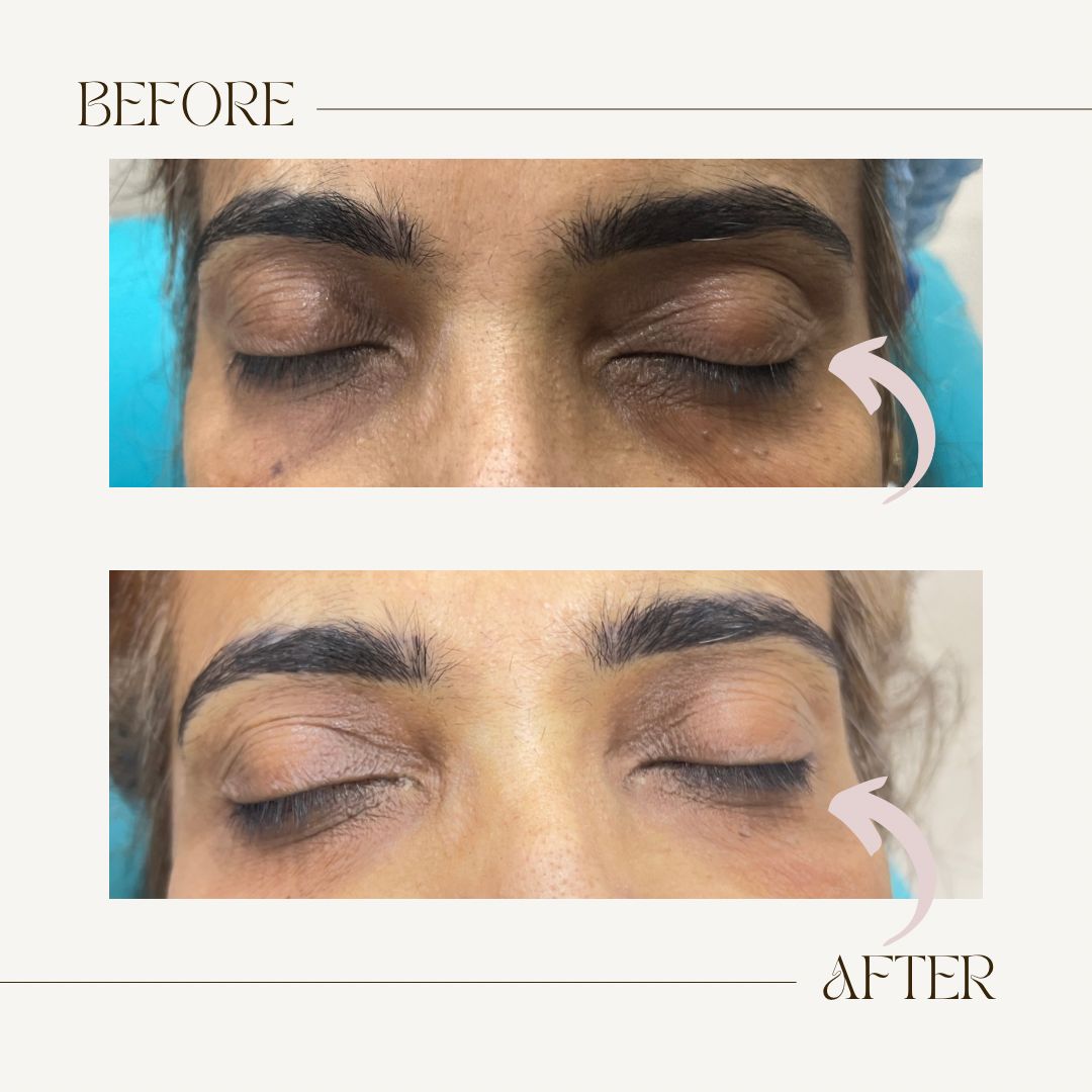 Clinical centrifuge for PRP hair growth treatment preparation