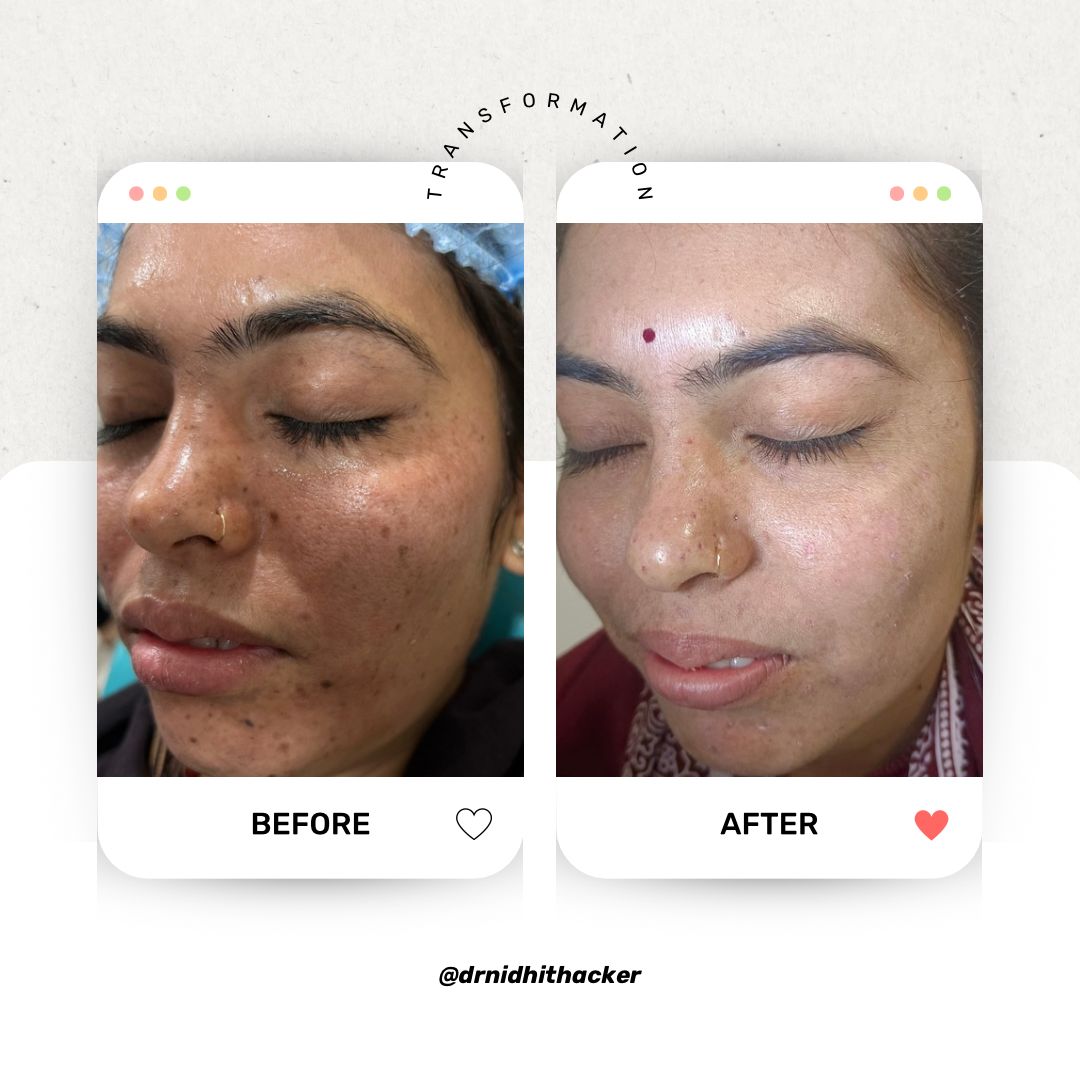 Laser toning device for carbon peels and hyperpigmentation